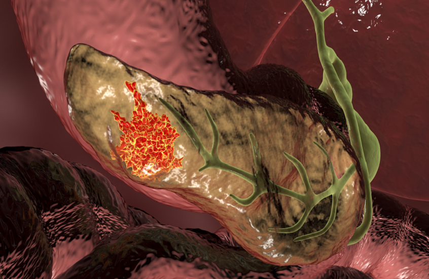 اكتشاف "زر إيقاف" سرطان البنكرياس قبل تطوره!