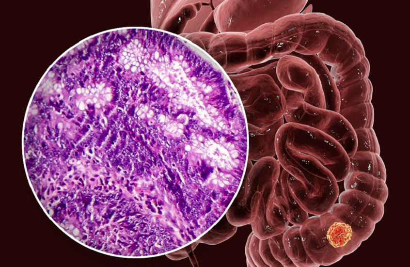 السبب الخفي وراء تفشي سرطان القولون بين الشباب!