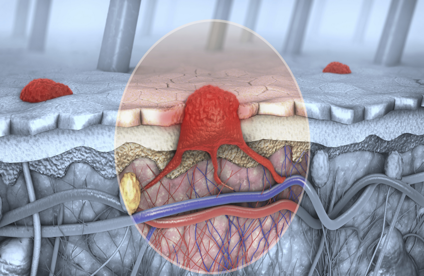 فيروس شائع الانتشار يساعد الجسم في محاربة سرطان الجلد!