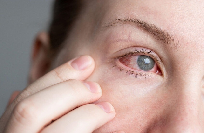 طرق بسيطة لترطيب العين دون استخدام القطرات الطبية