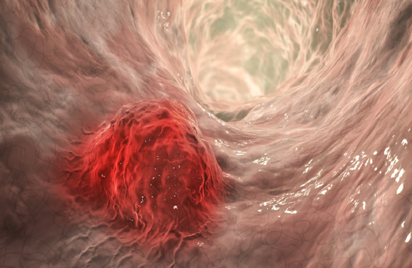 وجبة خفيفة شائعة تحارب سرطان الأمعاء