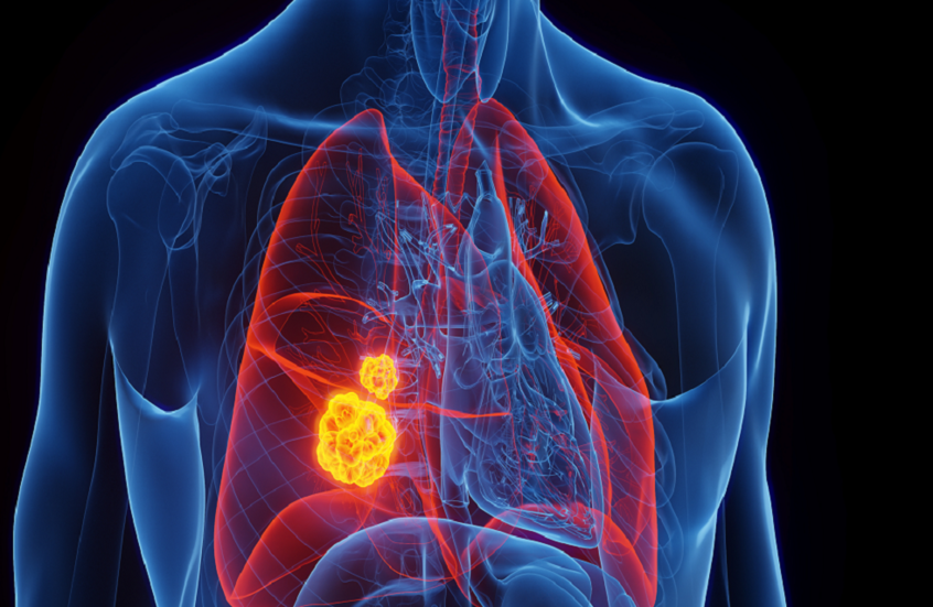 بروتين خاص بالخصيتين قد يكون محرّكا خفيا لسرطان الرئة