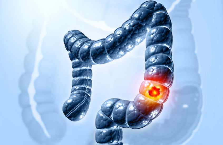 عادة يومية سيئة ترفع معدل الوفاة بسرطان القولون بنسبة صادمة