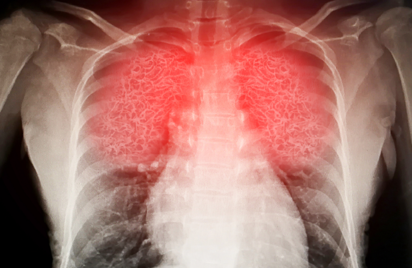 احذروا.. نشاط بدني شائع الانتشار قد يتسبب في تلف الرئتين