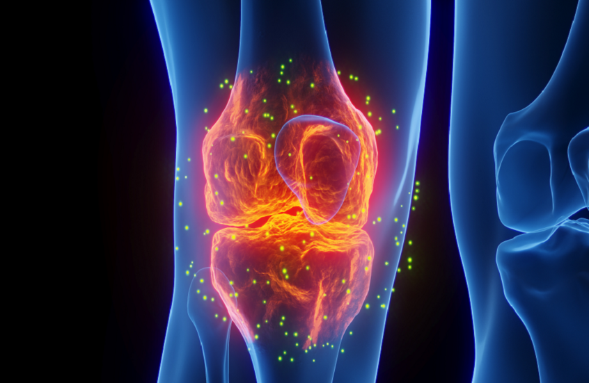 أبرز أسباب التهاب المفاصل التنكسي في الركبة
