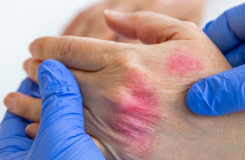 تطوير نموذج ذكاء اصطناعي لتشخيص مرض جلدي خطير