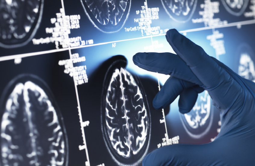 اكتشاف "المفتاح السحري" الذي يربط بين ألزهايمر والصرع