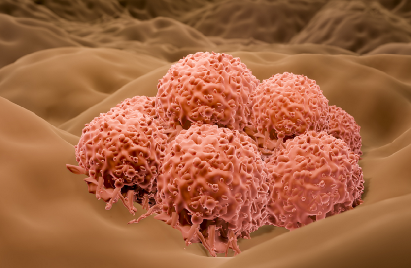 بعيدا عن الشامات..  علامات غير مألوفة قد تكشف أخطر أنواع سرطان الجلد