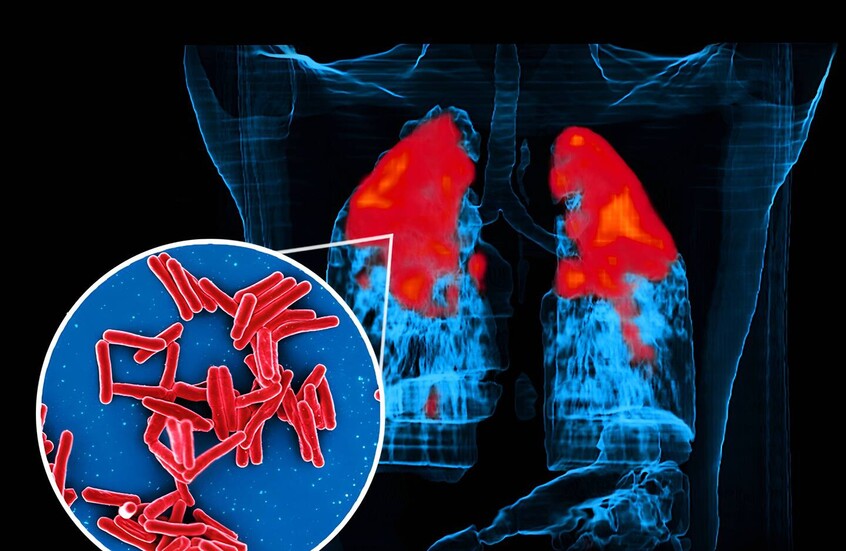 اكتشاف ثوري يمهد لمكافحة السل