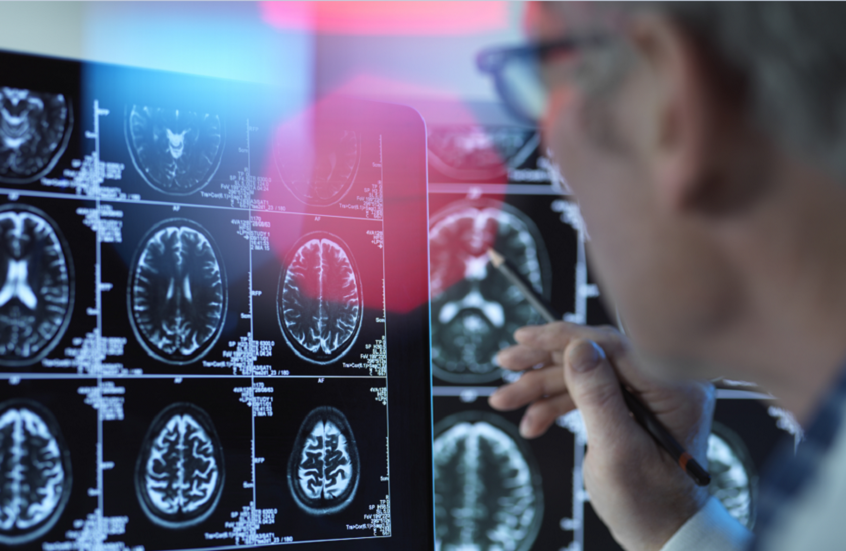 مؤشرات خفية على الخرف قد تسبق التشخيص بعقود