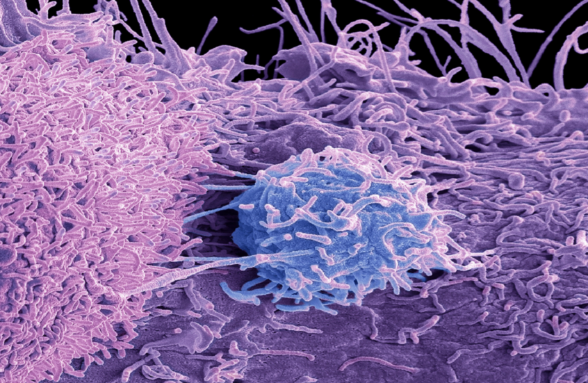 الذكاء الاصطناعي يمنح أملا جديدا لمرضى سرطان البروستات