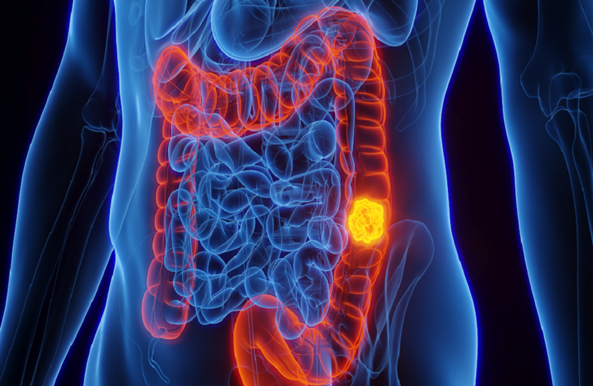 دراسة: التمارين الرياضية قد تحدث نقلة نوعية في علاج سرطان القولون
