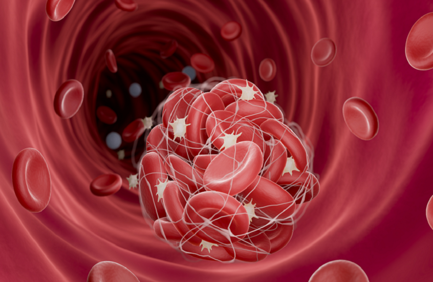ثورة طبية جديدة.. تقنية مبتكرة لإزالة جلطات الدم بفعالية مذهلة