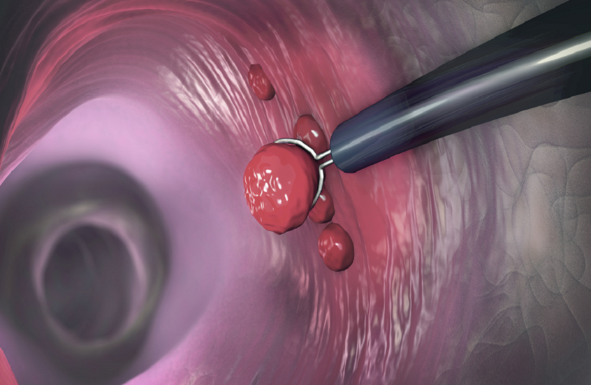 تحذير طبي جديد.. "سرطان نادر" يتفشى بين الشباب أسرع من سرطان القولون