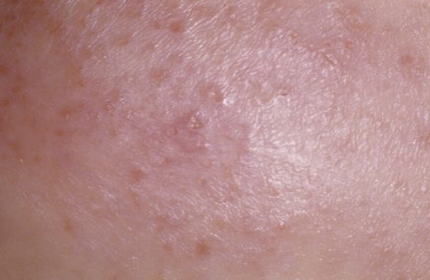 التهاب الجلد الضوئي.. الأسباب وطرق الوقاية