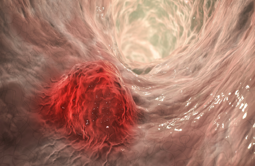 "أسبرين الأطفال".. أمل جديد للوقاية من سرطان الأمعاء