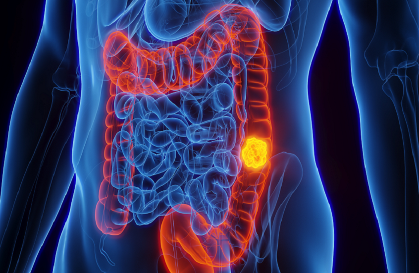 نوع شائع من التوابل قد يحارب سرطان الأمعاء القاتل