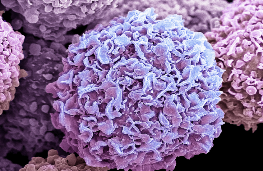 عامل مرتبط بنمط الحياة يزيد خطر الإصابة بسرطان الثدي