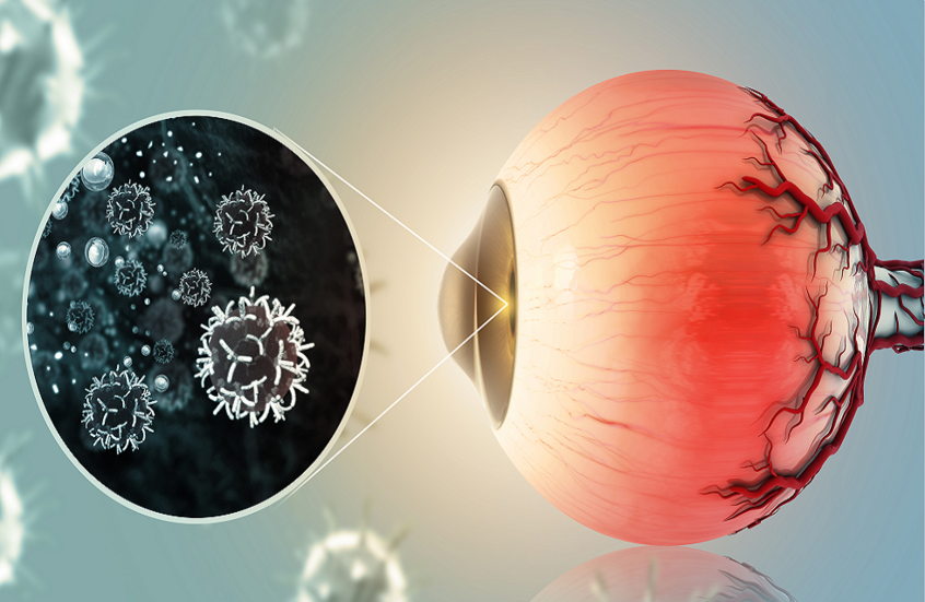 هدف علاجي جديد لسرطان عدواني يصيب العين