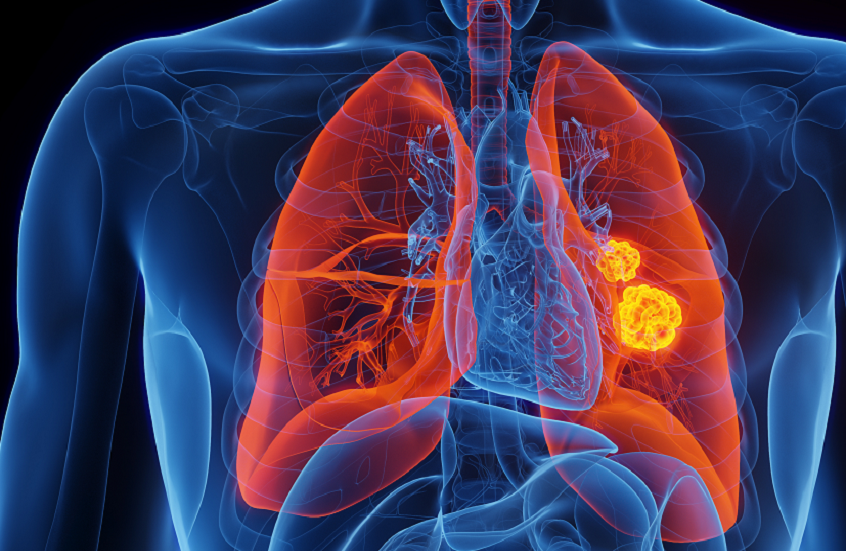 اكتشاف طريقة فعّالة لعلاج سرطانات الرئة