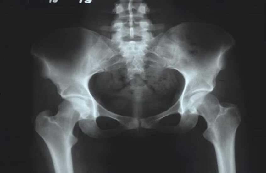 ما الذي يؤدي إلى تدمير المفصل؟