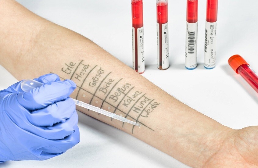 طبيبة تحدد نوع الحساسية غير القابل للعلاج