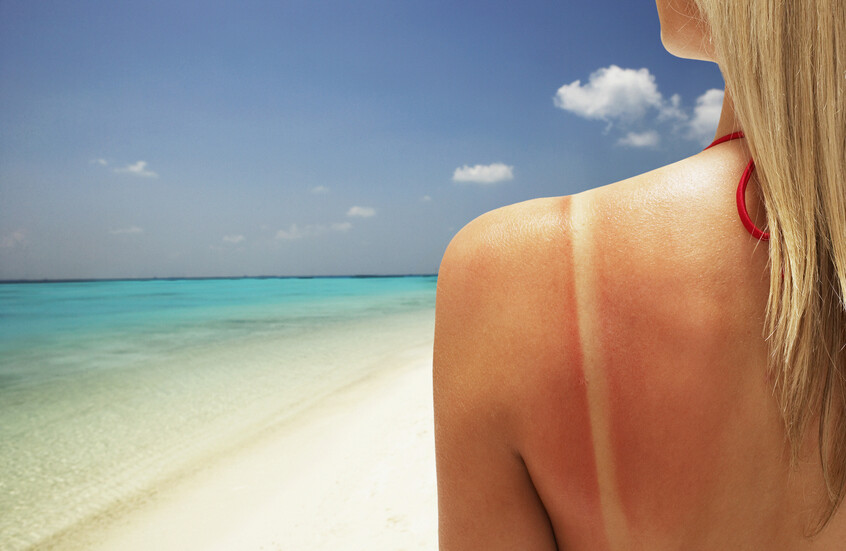 علاجات منزلية غير متوقعة ومثبتة علميا لحروق الشمس