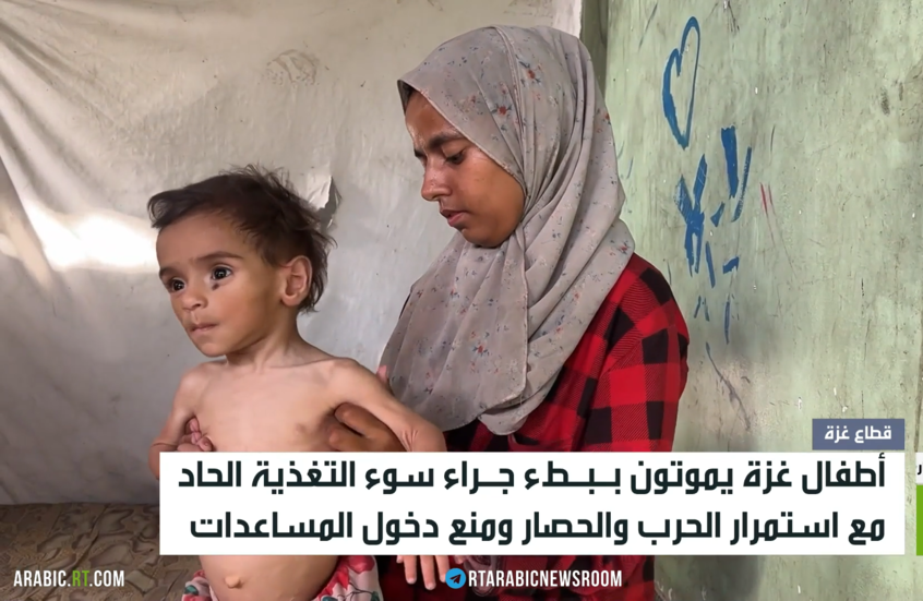 الجوع ينهش أجساد أطفال غزة