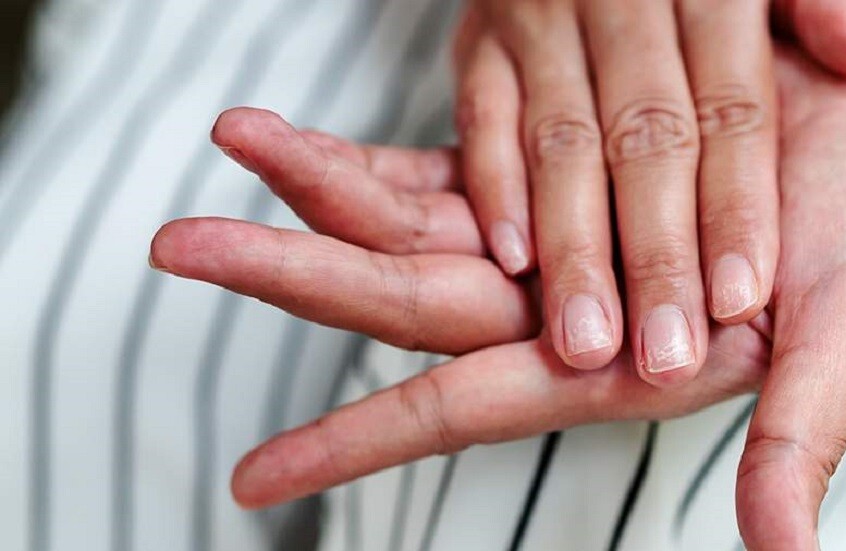 أسباب حرقة اليدين