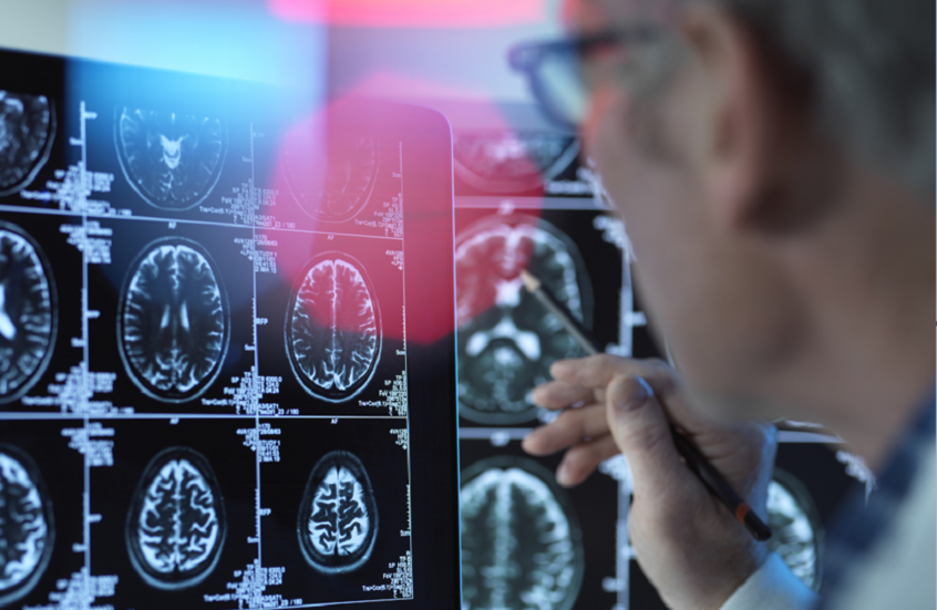 اكتشاف عامل خفي وراء الإصابة بالخرف