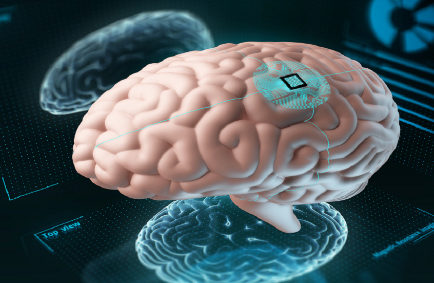 بعد 20 عاما من الشلل.. امرأة تعود للكتابة بقوة التفكير عبر شريحة "نيورالينك"