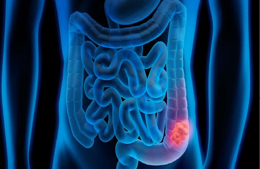 خطوات وأطعمة بسيطة "تحميك" من سرطان الأمعاء
