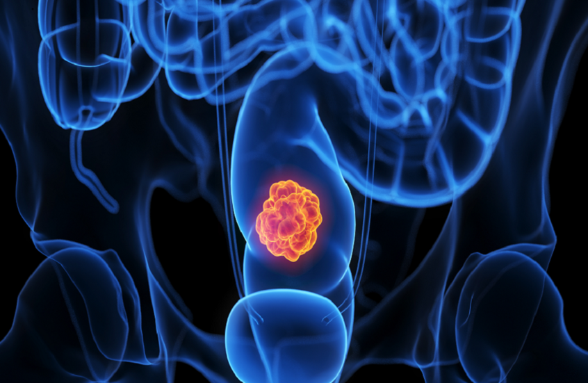 "ظاهره حميد".. خطر خفي في الأمعاء قد ينذر بتطور السرطان