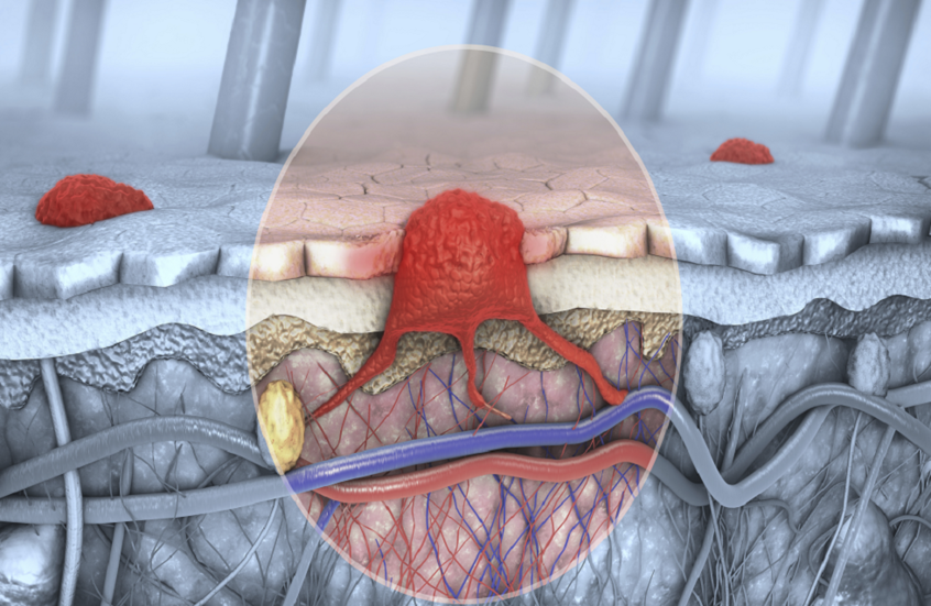 فيروس جنسي شائع قد يكون مرتبطا بنوع قاتل من سرطان الجلد