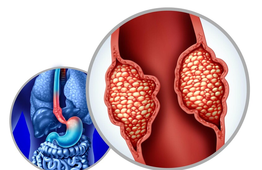 تقنية ثورية للكشف المبكر عن سرطان المريء