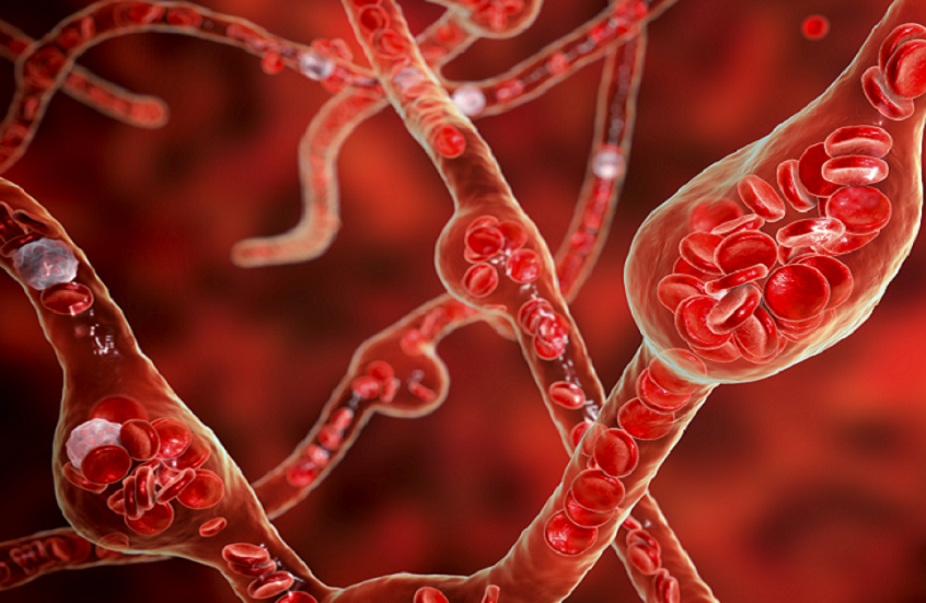 كيف تزيد الأطعمة الدهنية خطر الإصابة بالجلطات؟
