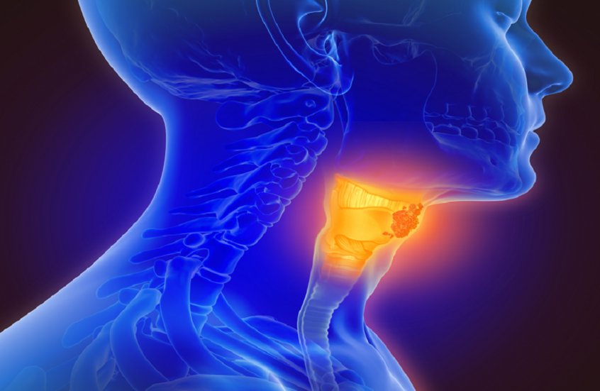 الذكاء الاصطناعي يكشف سرطان الحنجرة مبكرا عبر نبرة الصوت