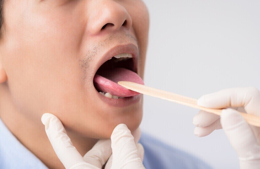 غير مؤلمة وغير ملحوظة.. علامات مبكرة لسرطان الفم