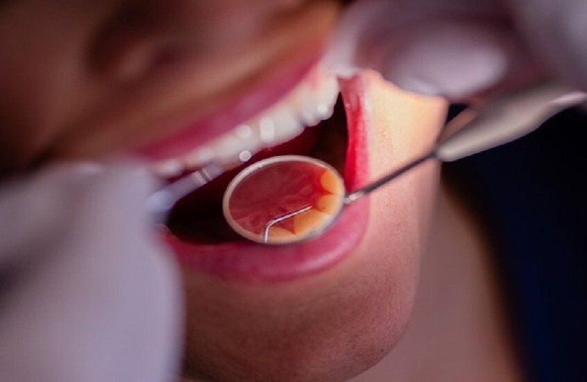 هل ينتقل التسوس عن طريق التقبيل؟