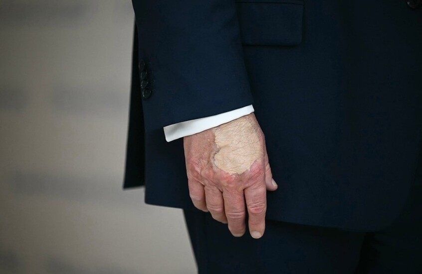 كدمة جديدة على يد ترامب اليمنى تثير التكهنات مجددا حول حالته الصحية