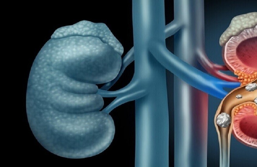 أطعمة تمنع تكون الحصى في الكلى