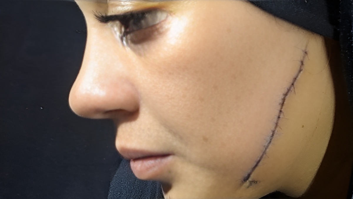جريمة مروعة في مصر.. طليقة شاب تشوه وجه عروسه قبل ليلة زفافها