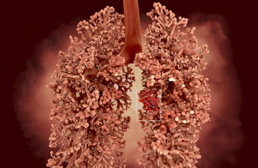 دواء جديد يعيد الأمل لمرضى أحد أكثر أنواع السرطان عدوانية