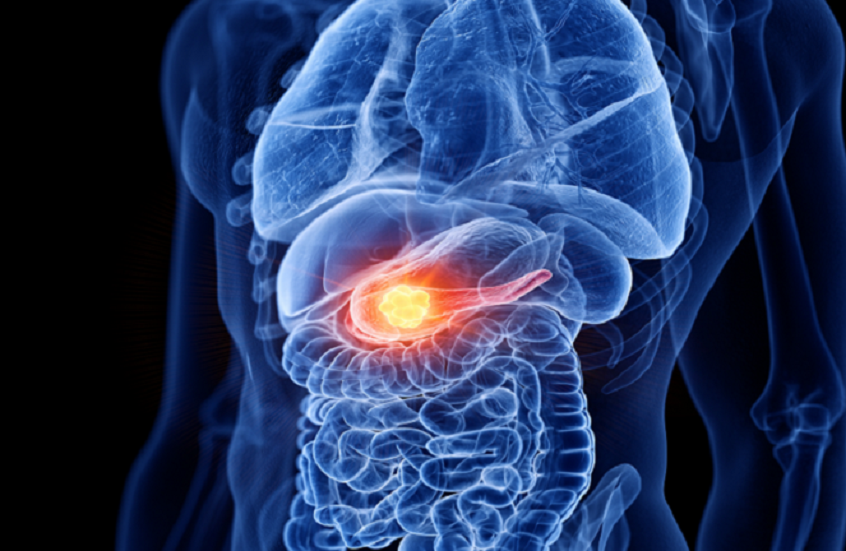 عادة تؤدي إلى سرطان البنكرياس