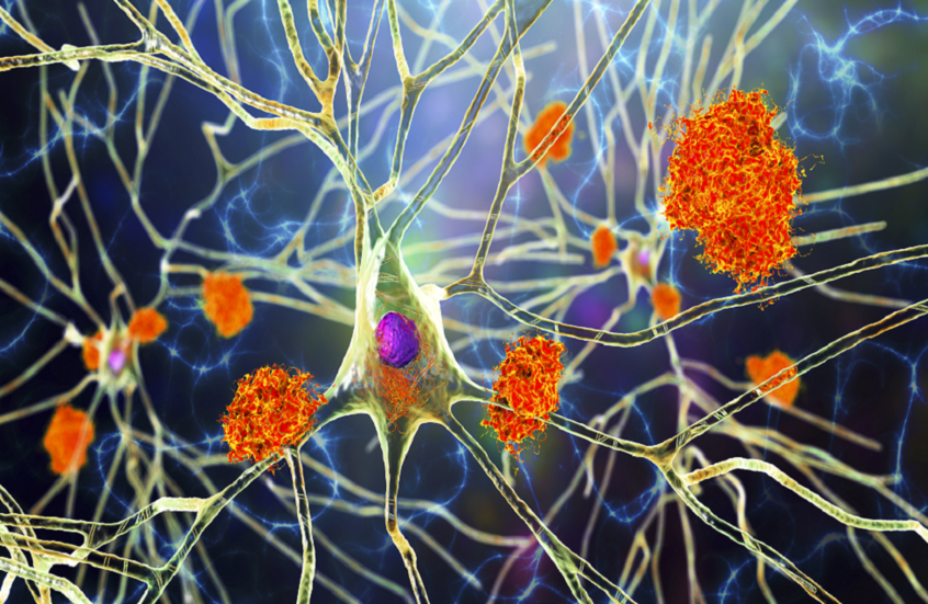 علامة مبكرة لمرض ألزهايمر قد تساعد على إبطاء تقدمه