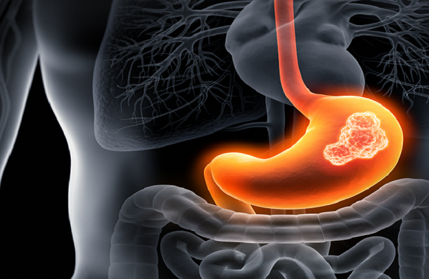 علامات غير نمطية قد تشير إلى سرطان المعدة