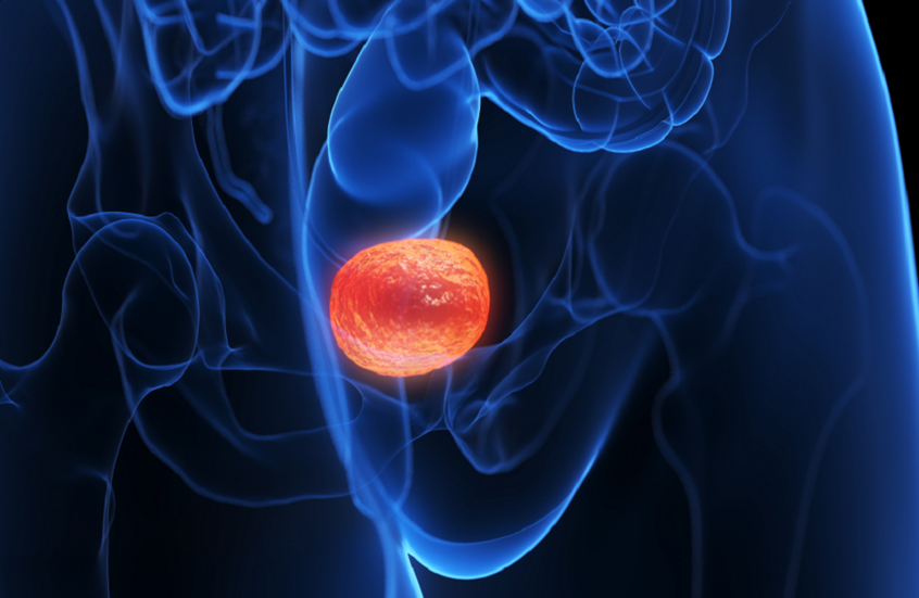 نوبة التهاب المثانة قد تكون أول علامة على سرطانات المسالك البولية