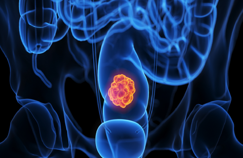 الأسبرين يثبت فعاليته في منع عودة سرطان القولون والمستقيم!