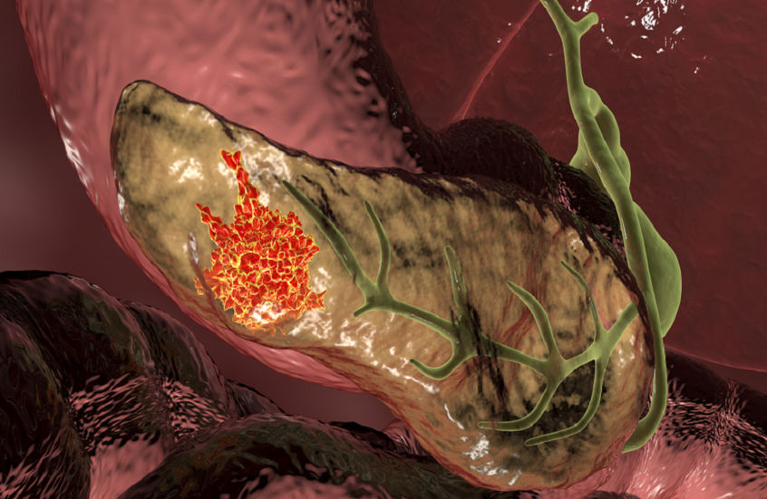 هدف علاجي واعد للحد من تطور أكثر أنواع سرطان البنكرياس شيوعا