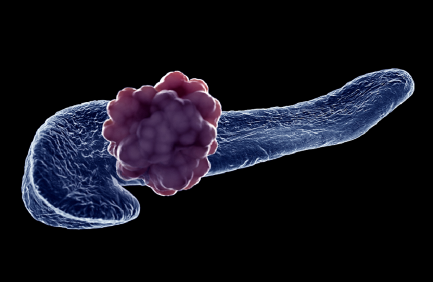 علماء يكتشفون عاملا رئيسيا يرفع خطر الإصابة بسرطان البنكرياس